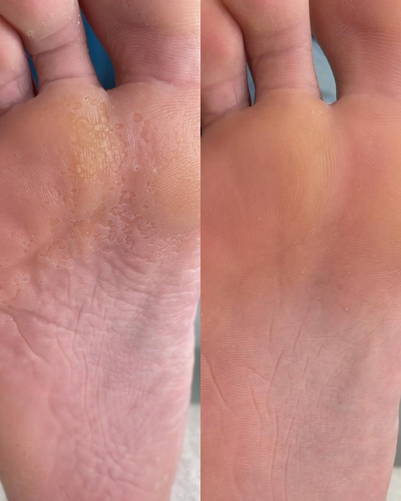 Creme tratamento com efeito antibacteriano NATI Callux.Pro®